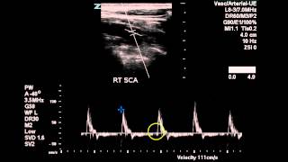 Bilateral Subclavian Artery Duplex  Case Study [upl. by Foote987]