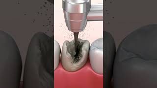 Tooth caries removal dentalcare dentalhygiene caries [upl. by Bartko]