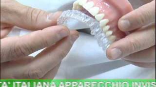 ODONTOIATRIA Invisalign  Apparecchio Invisibile [upl. by Sairacaz274]