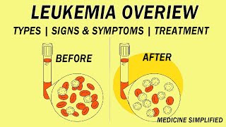 What is Leukemia  Classification Etiology Pathophysiology Clinical Features and Treatment [upl. by Abehsile651]