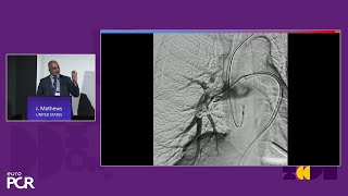 Advancing percutaneous treatment of pulmonary embolism with computerassisted vacuum thrombectomy [upl. by Fortna354]