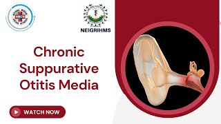 Chronic Suppurative Otitis Media [upl. by Ail]