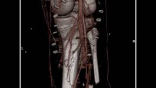 Vascular Leg 3D mapping demonstrates vascular mass of the left leg1 of 3 [upl. by Dianemarie]