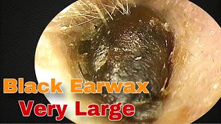 BIGGEST Earwax Difficult Removal EP 12  Doctor Anh [upl. by Bryce]