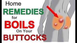 The 3 Most Effective Home REMEDIES for BOILS on BUTTOCKS  Boils BUTTOCKS Treatment for Fast Relief [upl. by Kare521]