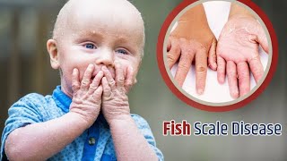 genetic disease ichthyosis vulgaris treatment videos fish scale disease treatment [upl. by Nazay]