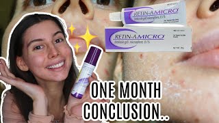 ONE MONTH REVIEW amp UPDATE OF TRETINOIN 1 BEFORE AND AFTERS  Heal acne scars [upl. by Kerek]