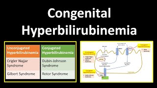 Conjugated Hyperbilirubinemia – Pediatrics  Lecturio [upl. by Sihunn922]