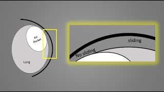 Ultrasound Evaluation of Respiratory Distress [upl. by Naejamron]