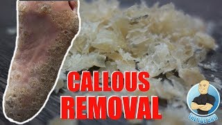 REMOVING EXTREMELY HARD FOOT CALLUS  CALLOUS FOOT [upl. by Inavihs]