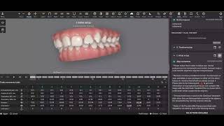 Carriere Motion Appliance  Invisalign [upl. by Narhem998]