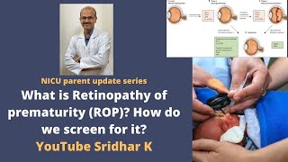 Retinopathy of prematurity in preterm babies Why do we screen for ROP how to treat Dr Sridhar K [upl. by Atnes893]