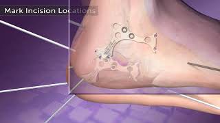 Calcaneal Fracture Animation [upl. by Lempres338]