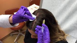 PRP injections for hair loss by Dr Rebecca Baxt [upl. by Chrysler]