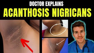 Doctor explains Acanthosis Nigricans  signs symptoms causes treatment and more [upl. by Alisun714]