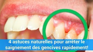 4 astuces naturelles pour arrêter le saignement des gencives rapidement c0ns3ils [upl. by Llenrub768]