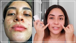 PRIMER MES CON TRATAMIENTO ANTI ACNÉ Con Epiduo Gel  Gabcamva [upl. by Xyla]