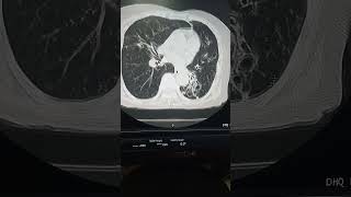 Bilateral bronchiectasis on CT scan CT scan chest interpretation [upl. by Oliric]