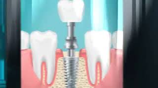 Planes odontológicos  implantes dentales [upl. by Ailiec]