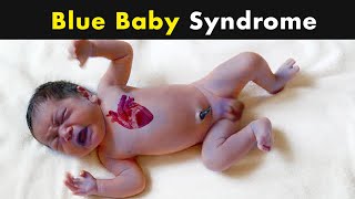 Cyanosis  Blue Skin Color in babies  Symptoms Causes and Treatment UrduHindi [upl. by Aloisia]