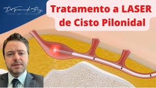 Tratamento a Laser de Cisto Pilonidal [upl. by Eet]