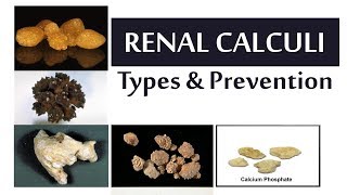 Renal Calculi Types and Prevention [upl. by Irina]