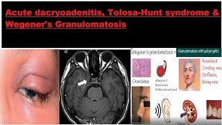 Acute dacryoadenitis Tolosa–Hunt syndrome amp Wegeners Granulomatosis kanskiseries 2022 2023 [upl. by Atsed]