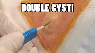 Smashs Pearl White Double Cyst Removal with Dr Gilmore [upl. by Haveman]