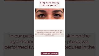 Upper eyelid blepharoplasty 🌼 gözkapağıestetiği blepharoplastysurgery beauty eyebrows [upl. by Huang]