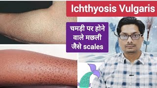 चमड़ी पर होने वाले मछली जैसे scales  Ichthyosis Vulgaris  Itchy dry fish like skin ichthyosis [upl. by Paget857]