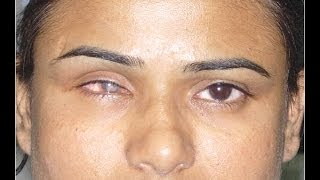 Shrunken Blind Eye Phthisis Bulbi Treated With Artificial Prosthetic Eye Fitting [upl. by Arimas984]