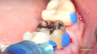 Tooth autotransplantation  Autotransplante Dental 36 [upl. by Damita]