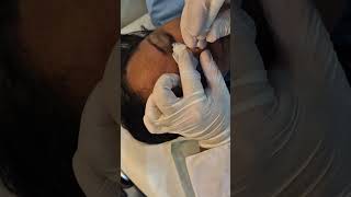 Retirada de sinal do nariz Nose mole removal [upl. by Airasor]