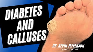 Diabetes and Calluses Removal of Thick Hard Calluses from Diabetes [upl. by Retlaw]