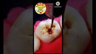 Dental filling procedure Tooth filling proceduresatisfying shorts [upl. by Meek988]