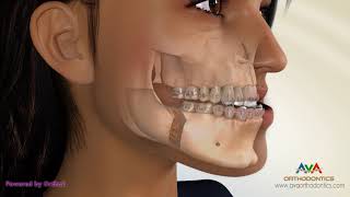 Surgical Orthodontic Treatment for Underbite or Crossbite  Transcortical Mandibular Setback [upl. by Tobias388]