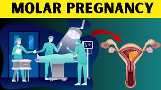 Molar Pregnancy Explained Types Symptoms Diagnosis and Treatment Hydatidiform Mole Overview [upl. by Pickar475]