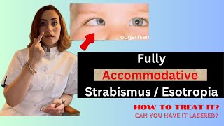 Fully Accommodative esotropia How to treat it [upl. by Adnoel]