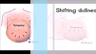 การฟัง Bowel sound การเคาะท้องประเมิน shifting dullness และ Fluid thrill ใหม่ [upl. by Kenway]