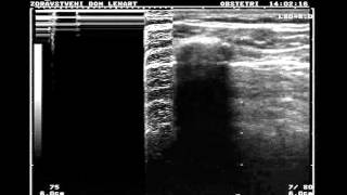 Normal lung vs pneumothorax [upl. by Bax7]