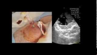 VSCAN Abscess in the femoral region Pocket Ultrasoundguided puncture absceso crural [upl. by Elokin]