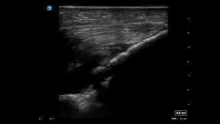 Elbow Ultrasound Arthrocentesis [upl. by Weinhardt]