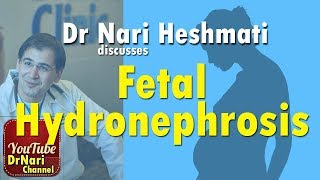 Fetal Hydronephrosis also known as pyelectasis or pelviectasis Discussed by Dr Nari Heshmati [upl. by Tirreg]