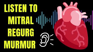 Listen to a Mitral Regurgitation heart murmur  and learn about causes symptoms and treatment [upl. by Trovillion]