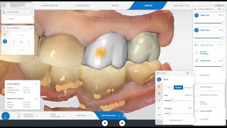 Cerec Primescan Design of Adjacent Crowns [upl. by Andee184]