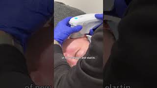 Ulthera or Ultherapy HIFU Skin Tightening Treatment  Sydney Australia [upl. by Trojan]