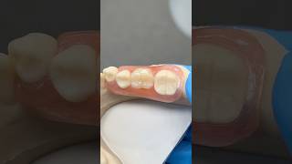 Unilateral Molar Partial ​⁠EnvisiontecMain envisiontec lsk121shorts dentist teeth [upl. by Odnalref]