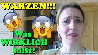 WARZEN ENTFERNEN  Was WIRKLICH hilft Und Ärzte nicht verraten Hausmittel  Schmerzfrei  Kinder [upl. by Mathe865]