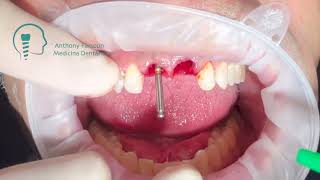 Exodontia  implantes imediatos no 11 e 21 FGM Arcsys [upl. by Eiser]