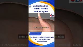 Understanding Hiatal Hernia and Its Types [upl. by Ringsmuth966]